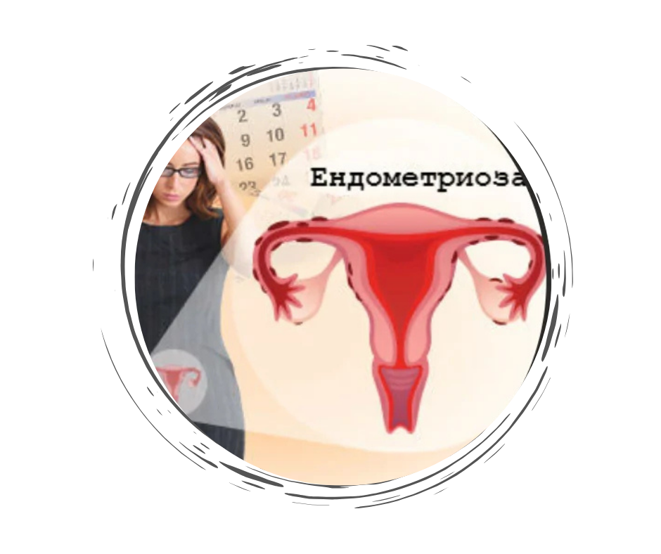 Хомеопатия при кисти и ендометриоза
